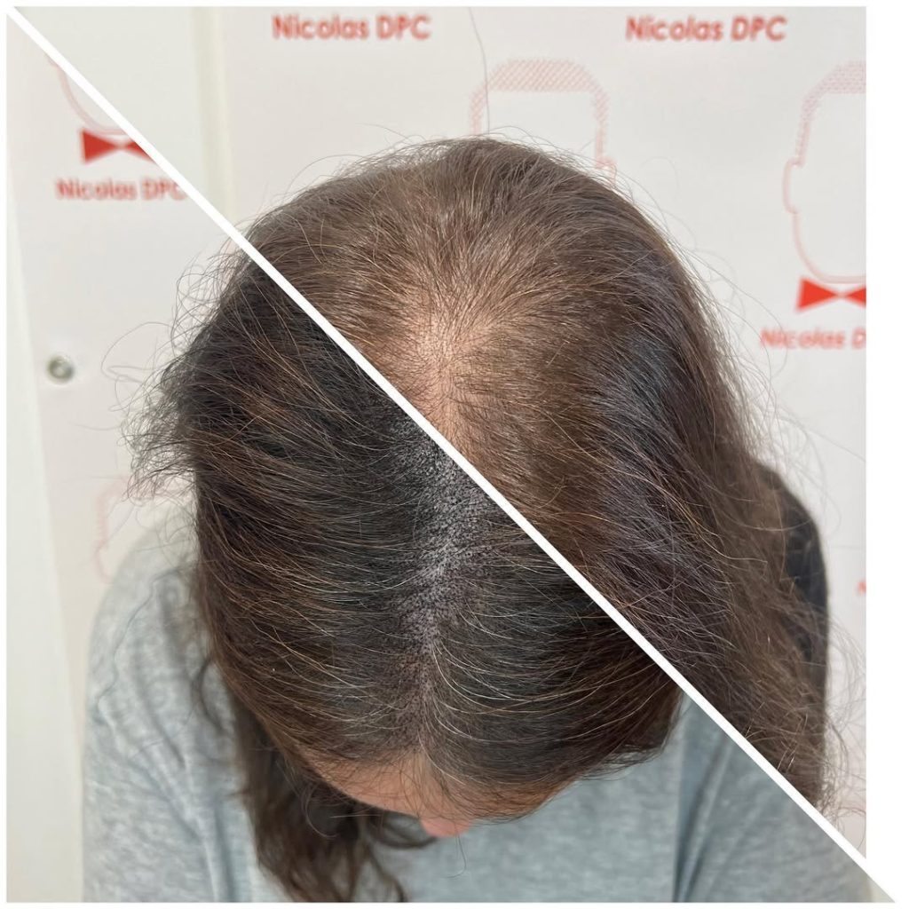 avant / après dermopigmentation capillaire sur alopécie féminine