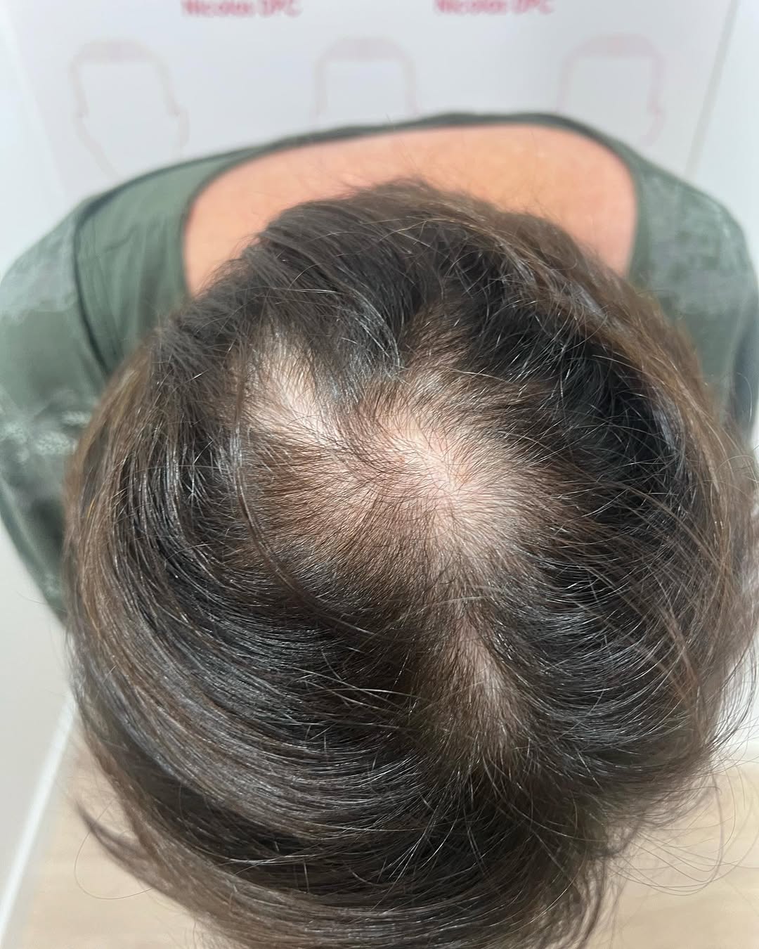 Alopécie féminine avant dermopigmentation