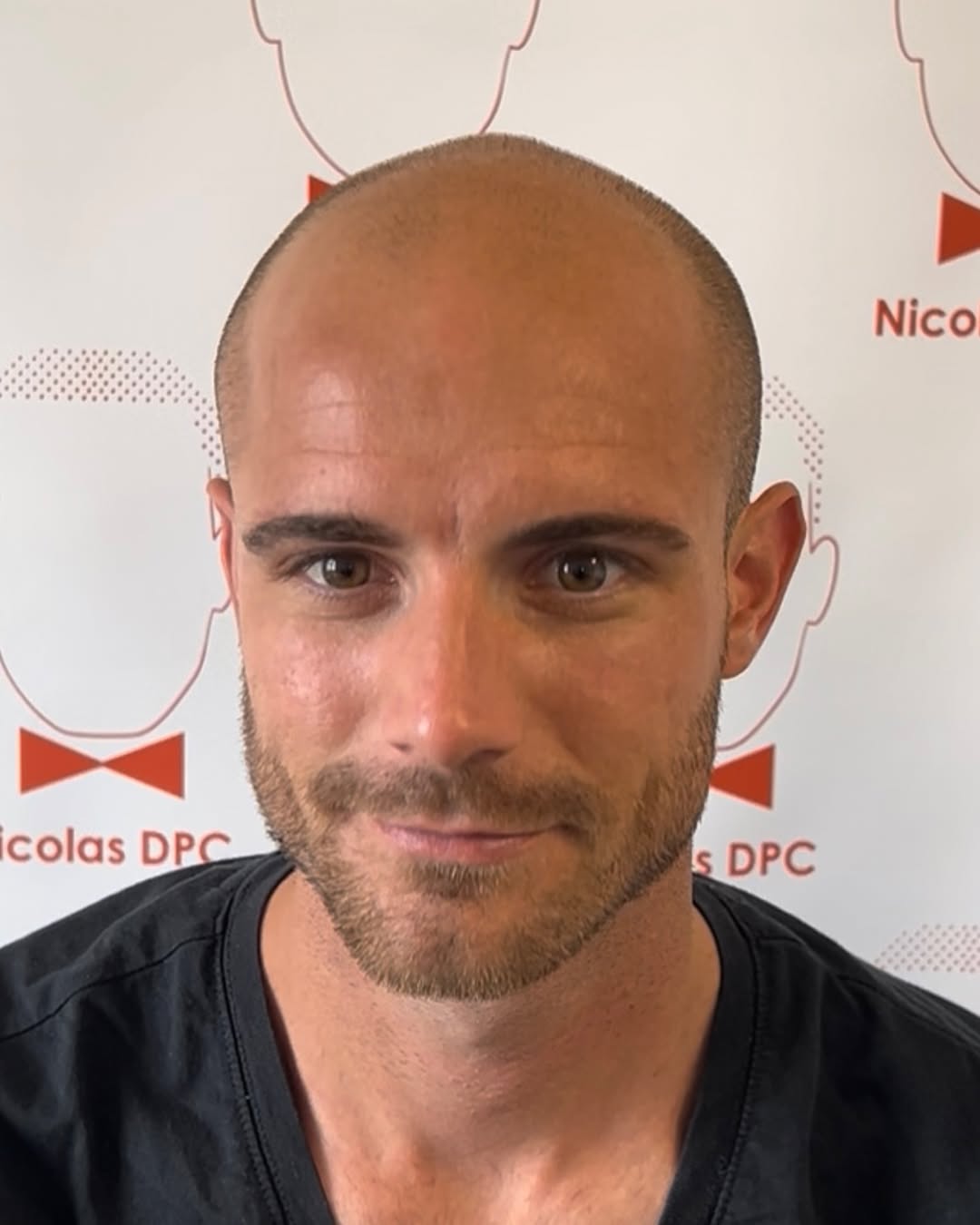 Avant dermopigmentation capillaire sur calvitie masculine