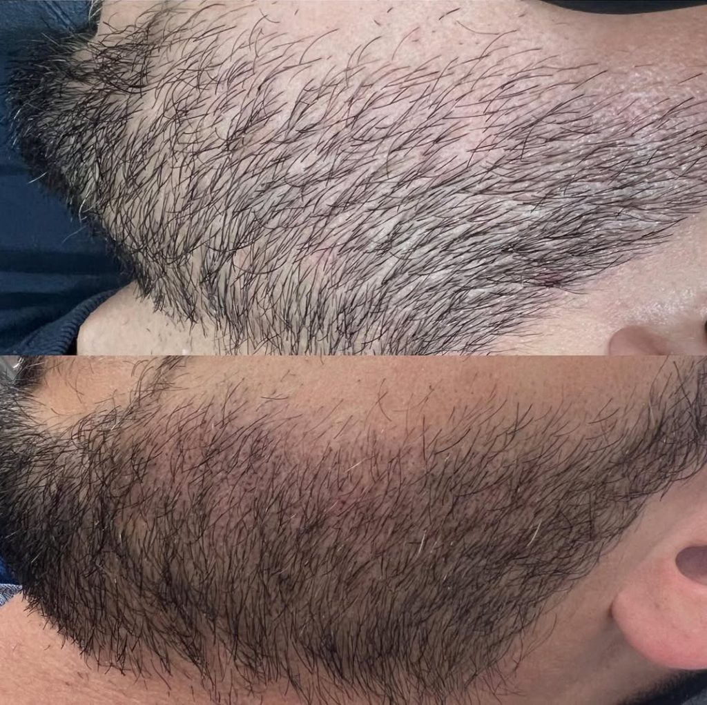 Résultat avant / après dermopigmentation sur une barbe clairsemée