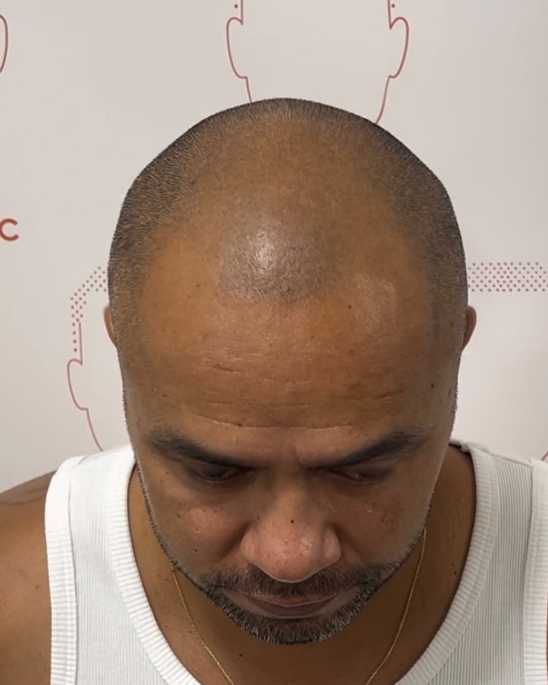 Calvitie peau noire avant séance dermopigmentation chez Nicolas DPC